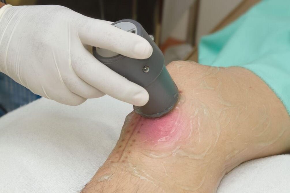 Phonophorese-Verfahren bei Arthritis des Kniegelenks. 