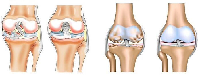 Unterschied zwischen Arthritis (links) und Osteoarthritis (rechts) der Gelenke