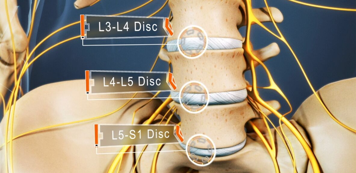 Bandscheiben der Lendenwirbelsäule, die bei Osteochondrose am häufigsten betroffen sind. 