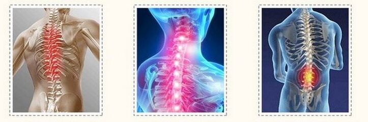 Osteochondrose verschiedener Säulen