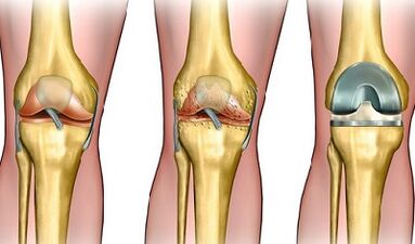 Der Entwicklungsgrad der Arthrose des Kniegelenks