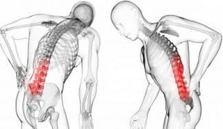 Schwungshernien Komplikation mit Osteochondrose