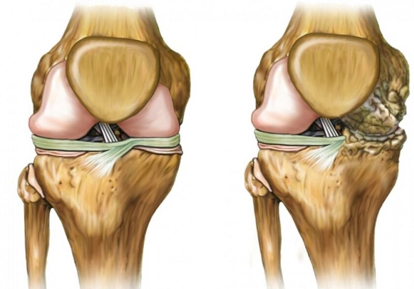 Knie -Arthrose