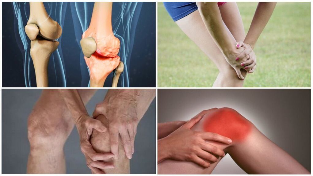Stadien der Arthrose