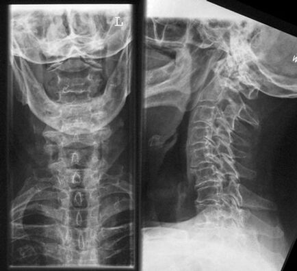 Cervical X -RAY - Diagnoseverfahren der Osteochondrose