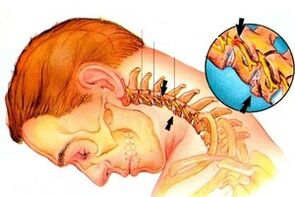 Nervenklemmung in der Säule mit zervikaler Osteochondrose