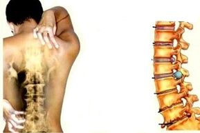 Rückenschmerzen in verschiedenen Stadien der Entwicklung der zervikalen Osteochondrose