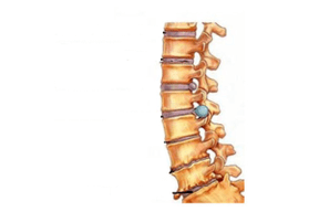 Schädigung der Wirbelsäule mit zervikaler Osteochondrose