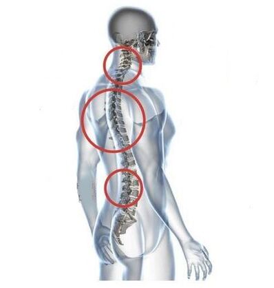 Osteochondrosestellen der Wirbelsäule