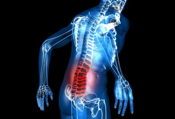 Was ist lumbale Osteochondrose