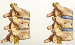 Wie sieht Osteochondrose aus