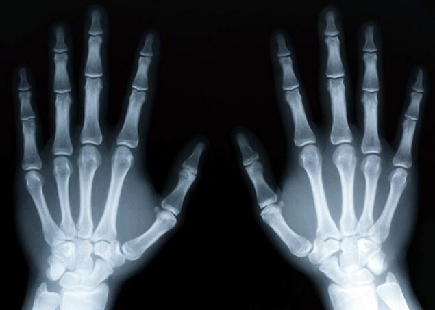 Gicht führt zur Entwicklung einer Gichtarthritis, die durch Röntgenaufnahmen diagnostiziert werden kann.