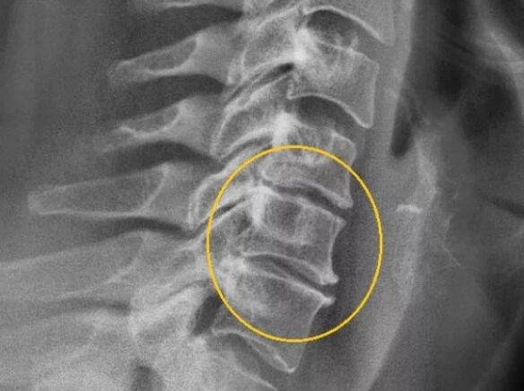 Osteochondrose der Halswirbelsäule im Röntgenbild.